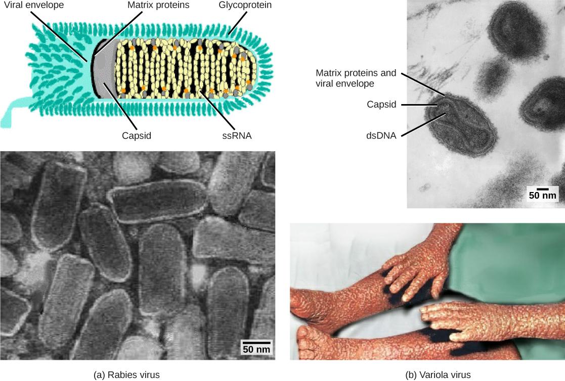 Part a (top) is an illustration of the rabies virus, which is bullet-shaped. RNA is coiled inside a capsid, which is encased in a matrix protein-lined viral envelope studded with glycoproteins. Part a (bottom) is a micrograph of a cluster of bullet-shaped rabies viruses. Part b (top) is a micrograph of variola virus, which has DNA encased in a bow-shaped capsid. An oval matrix protein-lined envelope surrounds the capsid. Part b (bottom) shows irregular, bumpy lesions on the arms and legs of a person with 