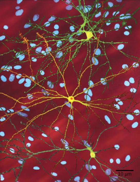 Micrograph shows a neuron with nuclear inclusions characteristic of Huntington’s disease.