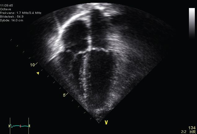 This is an ultrasound picture of a normal heart showing all 4 chambers.