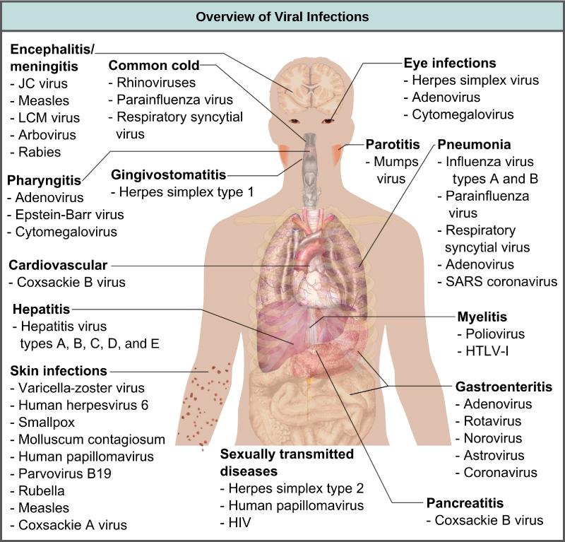 The illustration shows an overview of human viral diseases. Viruses that cause encephalitis or meningitis, or inflammation of the brain and surrounding tissues, include measles, arbovirus, rabies, JC virus, and LCM virus. The common cold is caused by rhinovirus, parainfluenza virus, and respiratory syncytial virus. Eye infections are caused by herpesvirus, adenovirus, and cytomegalovirus. Pharyngitis, or inflammation of the pharynx, is caused by adenovirus, Epstein-Barr virus, and cytomegalovirus. Parotit