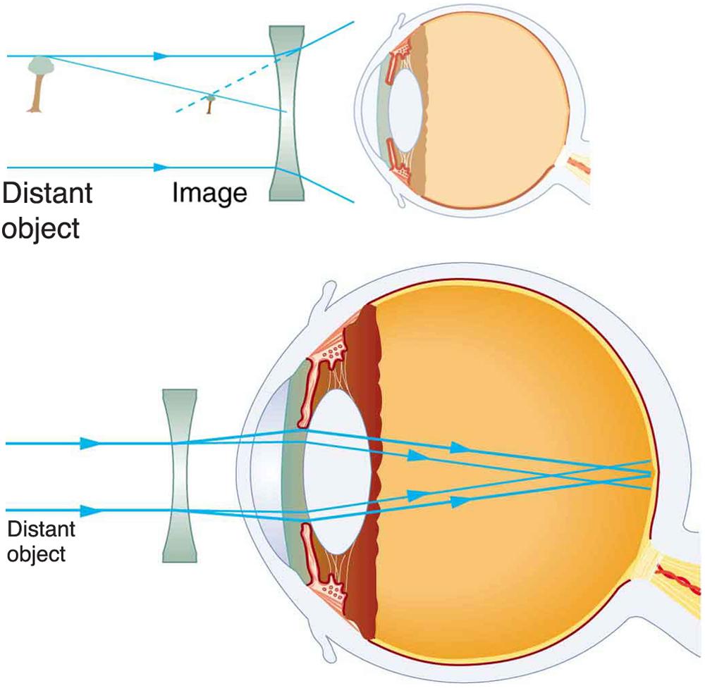 Two illustrations of cross-sectional view of an eye are shown. In the first figure, a diverging spectacle lens is placed in front of the eye structure. A ray diagram for the diverging lens is also shown. Parallel rays from a distant object, taken as tree, are striking the lens and then diverging. A smaller image of the tree is shown in front of the lens. In the second figure, a ray diagram with respect to the diverging lens within the eye structure is shown. Parallel rays from a distant object are strikin
