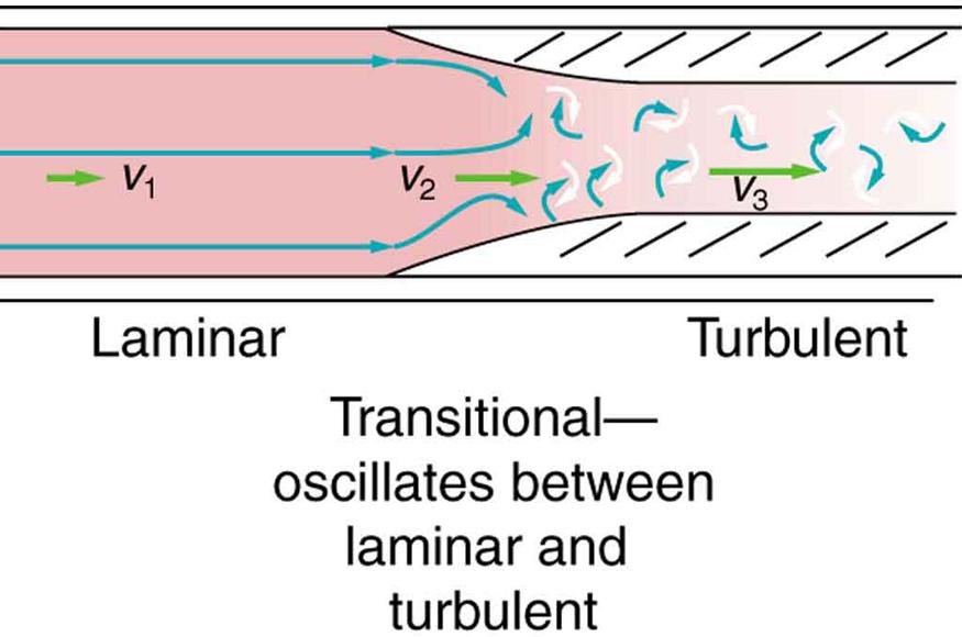 Figure shows a rectangular section of a blood vessel. The blood flow is shown toward right. The blood vessel is shown to be broader at one end and narrow toward the opposite end. The flow is shown to be laminar as shown by horizontal parallel lines. The velocity is v one in the broader section of blood vessel. The junction where the tube narrows the velocity is v two. The lines of flow are shown to bend. The regions where the blood vessels are narrow, the flow is shown to be turbulent as shown to by curli