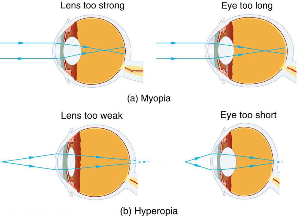 Part a shows two figures of cross-sectional area of eye depicting myopia. In both the figures, parallel rays coming from an object placed at infinity are converging in front of the retina. Figure on the left shows the lens of the eye too strong and figure on the right illustrates the shape of the eye too long. Part b shows two figures of cross-sectional area of eye depicting hyperopia. In both the figures, rays coming from a close object are shown which are converging at the back of the retina. Figure on 