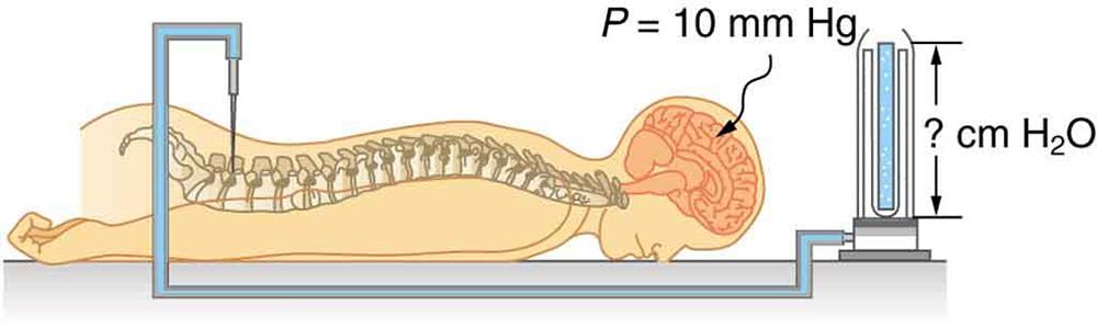 Diagram of a person lying face-down on a table hooked up to a medical apparatus. A needle attached to a tube is inserted between the patient's vertebrae in the lower back area. The tube, which appears to be filled with fluid, is connected to an upright tube containing an unknown amount of water. The height of the water in the tube is labeled question-mark centimeters H 2 O. A label pointing to the patient's head reads P equals ten millimeters H g.