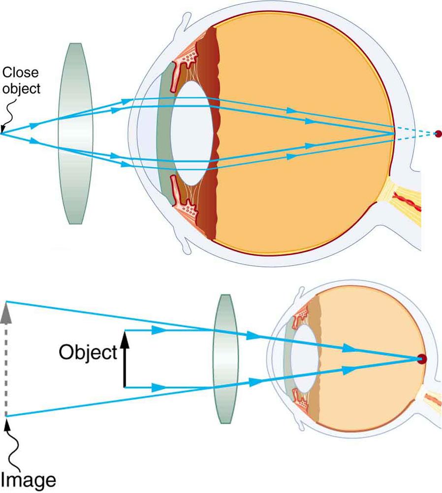 Two illustrations of a cross-sectional view of an eye are shown. In the upper part of the figure, a converging lens is placed in front of the eye structure and a close object before it. A ray diagram showing the rays from the object are striking the lens; converging a bit and entering the eyes; converging again through the eye lens and forming an image at the retina, and another set of rays converge behind the retina. The lower part of the figure shows a virtual image, an object, a converging lens, and th