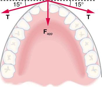 Cross-section of jaw with sixteen teeth is shown. Braces are along the outside of the teeth. Three forces are acting on the protruding tooth. The applied force, F sub app, is shown by an arrow vertically downward; a second force, T, is shown by an arrow making an angle of fifteen degrees below the positive x axis; and a third force, T, is shown by an arrow making an angle of fifteen degrees below the negative x axis.