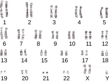 This image is a karyotype showing the 22 pairs of human autosomes and a pair of sex chromosomes. The autosomal chromosome pairs consist of two stick-like structures of approximately the same length and shape. Each pair is labeled 1 through 22. Chromosome pairs 1 and 2 are the longest. Chromosome pairs 21 and 22 are the shortest. The sex chromosomes are labeled as X and Y. The two X chromosomes are significantly longer than the Y chromosomes.
